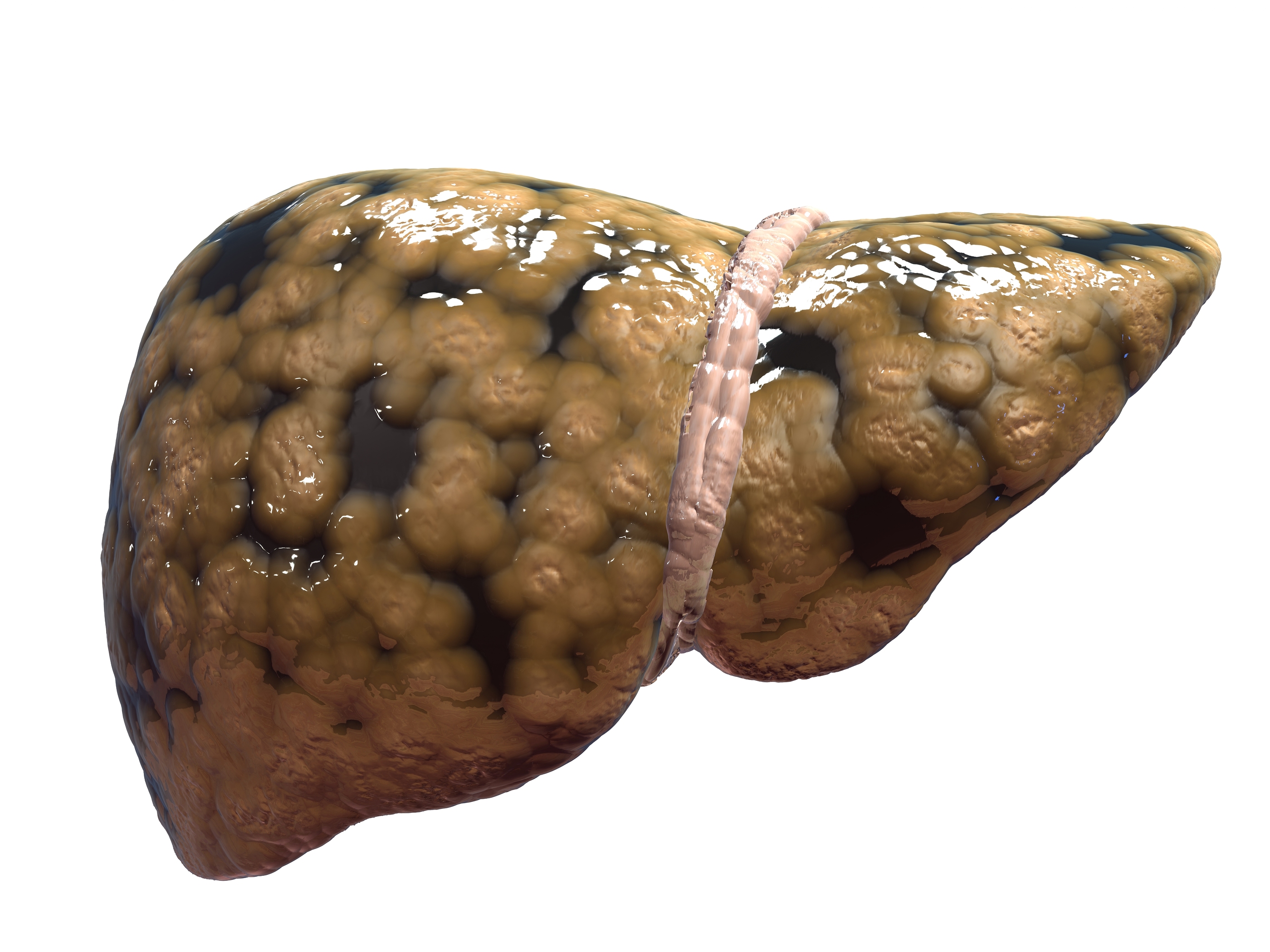 Baliga Diagnostics Pvt Ltd Fatty Liver What Is It Pictures Wallpapers