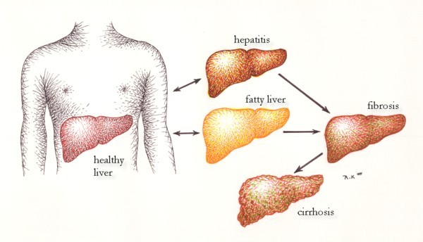Causes Of Cirrhosis Of Liver Healthy Liver And Cancer Pictures Wallpapers