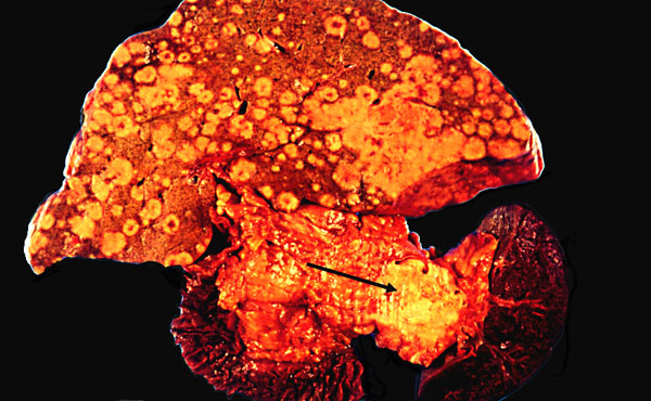 Liver Cancer Signs And Symptoms Living With Liver Cancer Pictures Wallpapers