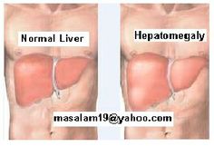 Liver Enlargement Symptoms Pictures Wallpapers