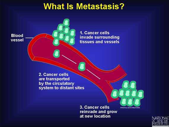 Metastatic Cancer Pictures Wallpapers