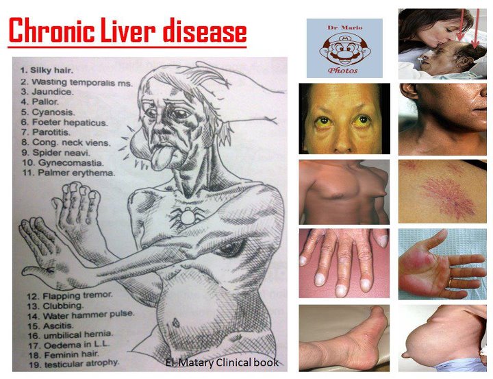 Signs Of Liver Cancer Pictures Wallpapers
