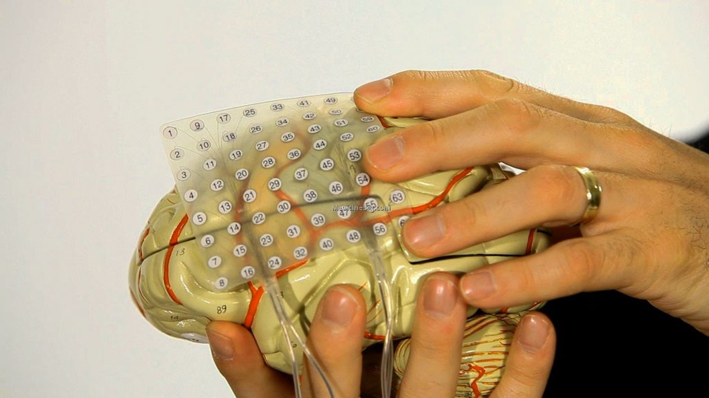 Brain Surgery Epilepsy Pictures Wallpapers