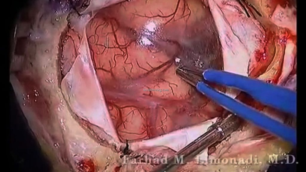 Brain Surgery Tumor Removal Pictures Wallpapers