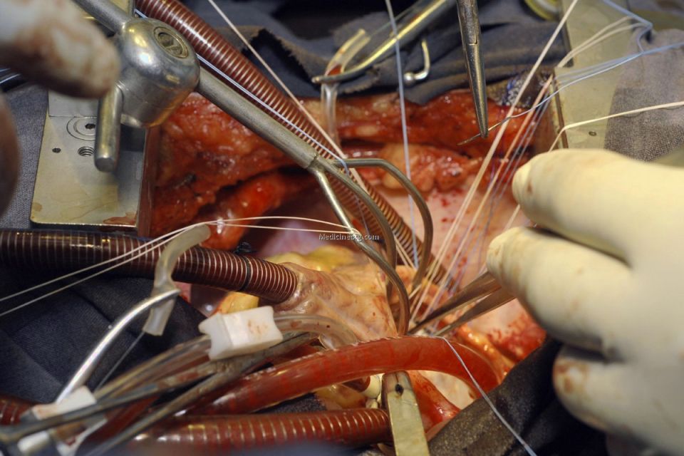 first heart transplant surgery