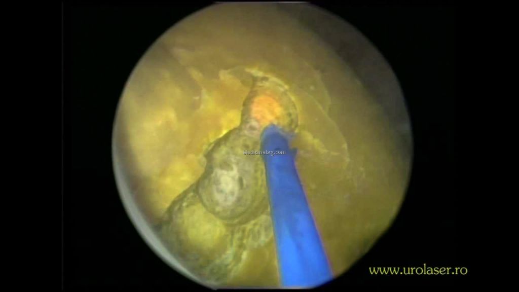 Laser Lithotripsy Pictures Wallpapers
