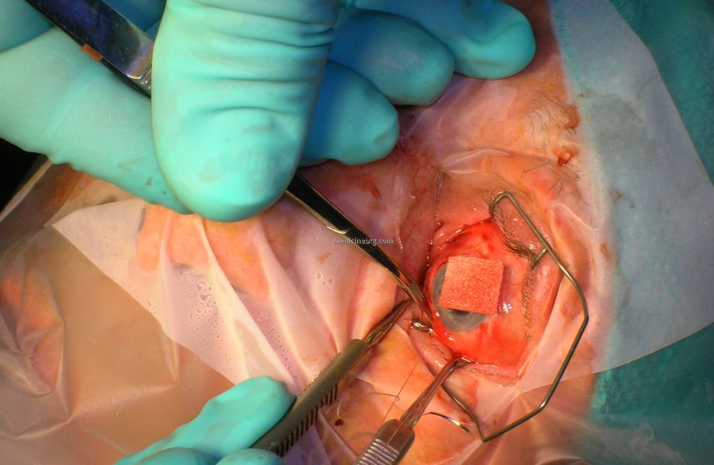 Open Eye Surgery Pictures Wallpapers