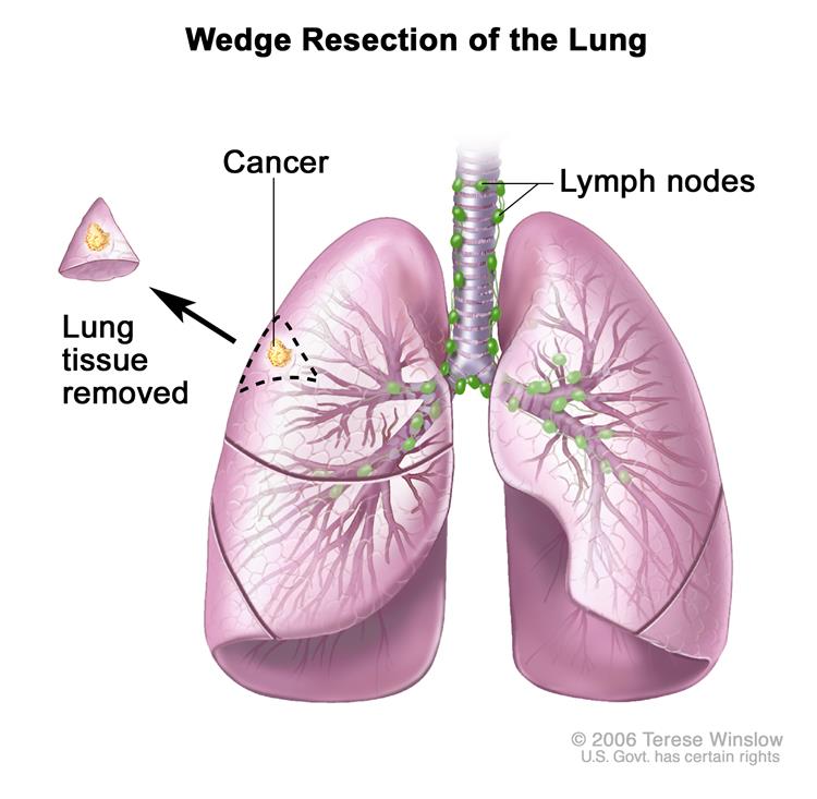 Enlarge Wedge resection of the lung