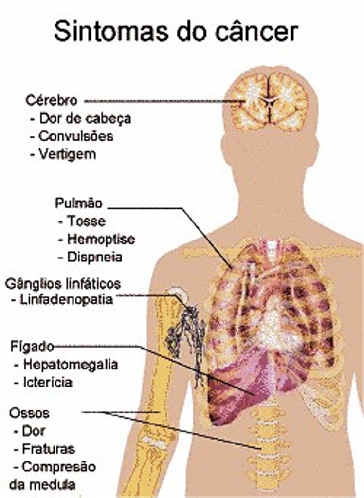 Sintomas do câncer