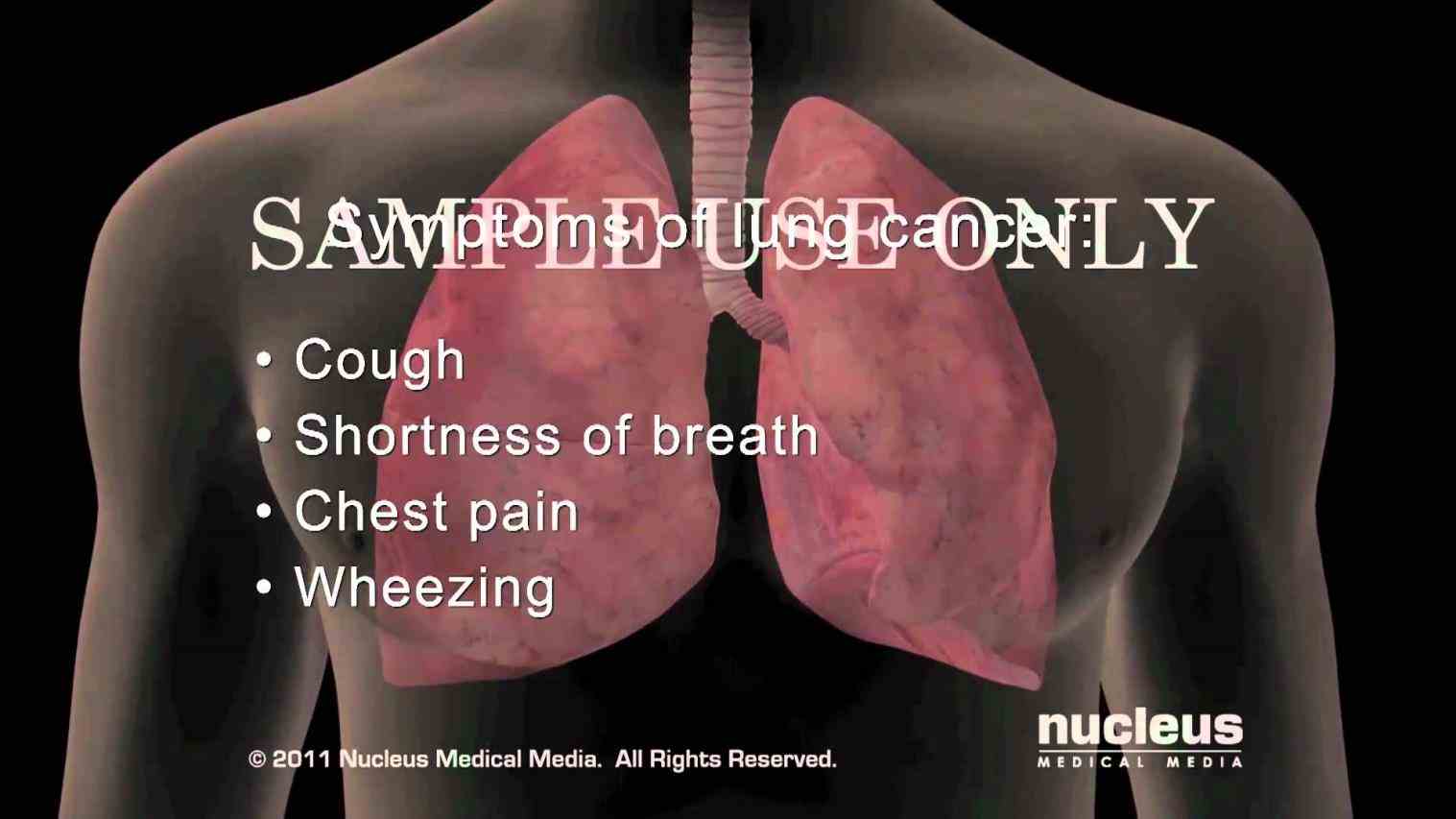 The Lungs Symptoms early symptoms of lung cancer may