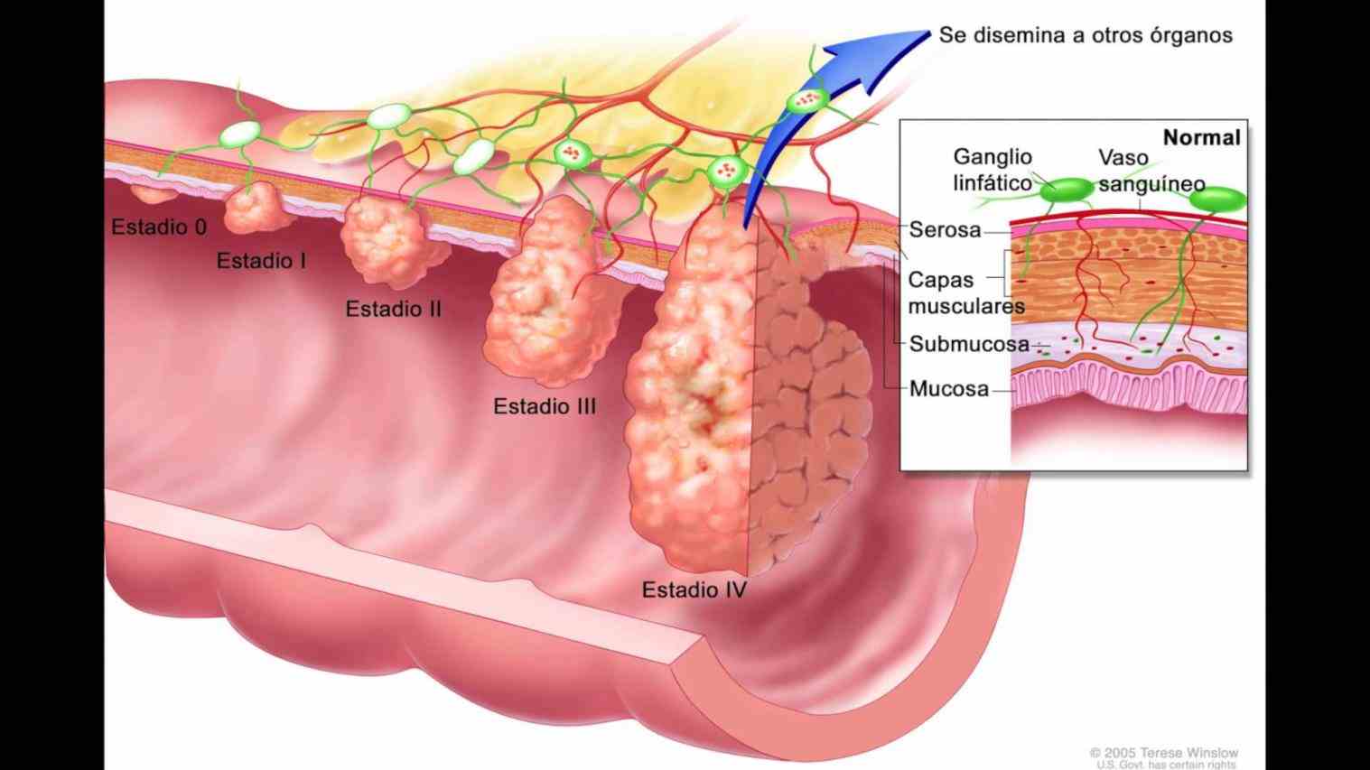 Cancer Sintomas Pictures Wallpapers