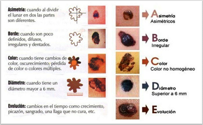 los síntomas del cáncer de piel en niños