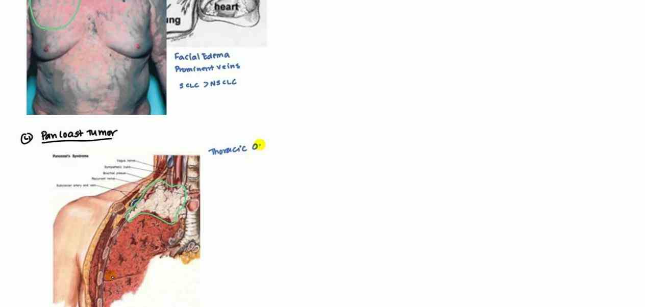 type of squamous carcinoma adenocarcinoma and large are all 