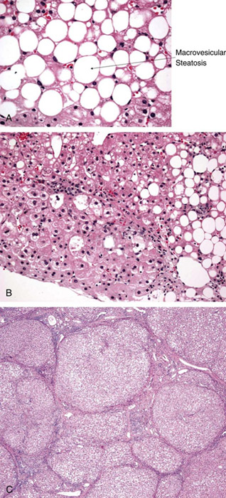 Fatty Liver Disease Treatment Pictures Wallpapers