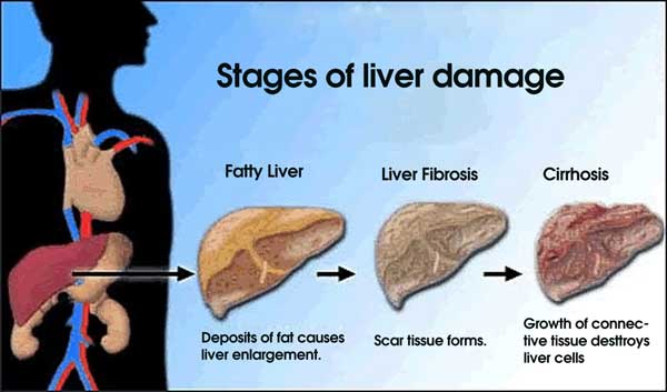 How To Fix Fatty Liver On Pinterest Pictures Wallpapers
