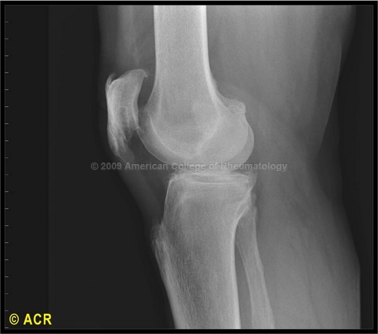 Non Alcoholic Fatty Liver Disease Wikipedia The Free Encyclopedia Pictures Wallpapers