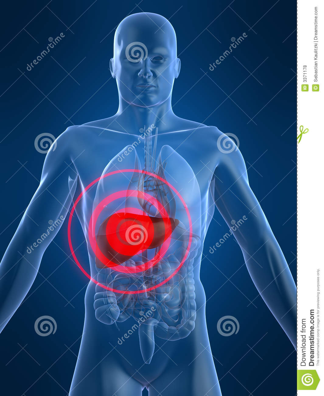 Cirrhosis Stock Photos Cirrhosis Stock Photography Cirrhosis Pictures Wallpapers