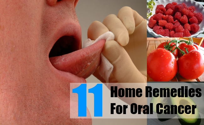 rp_Home Remedies For Oral Cancer.jpg