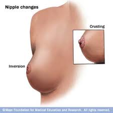 Breast Lump Cancer Symptoms Khxwuafy