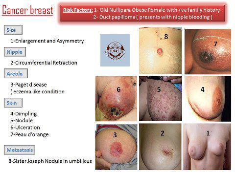 Breast Pain Cancer Symptoms Pictures Wallpapers