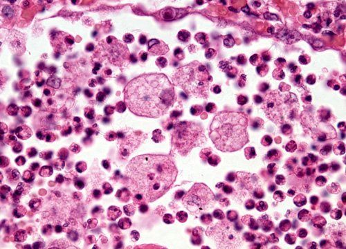 Nikon Microscopyu Digital Image Galleries Human Pathology Pictures Wallpapers