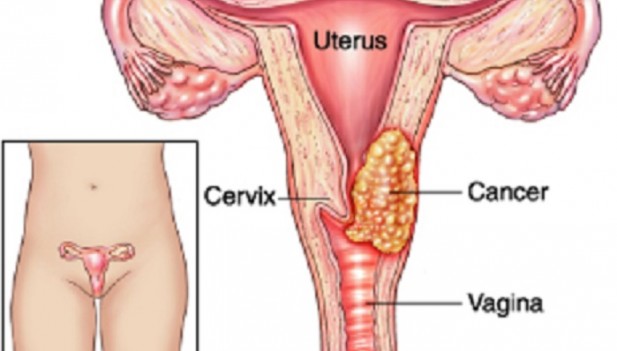Cancer Uterino Pictures Wallpapers