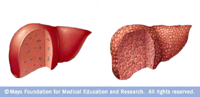 First Signs Of Liver Damage Healthy Liver And Cancer Zfieuqm