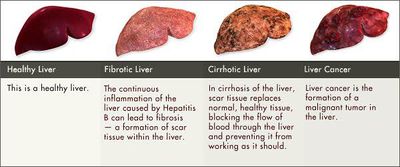 Hepatic Carcinoma Pictures Wallpapers