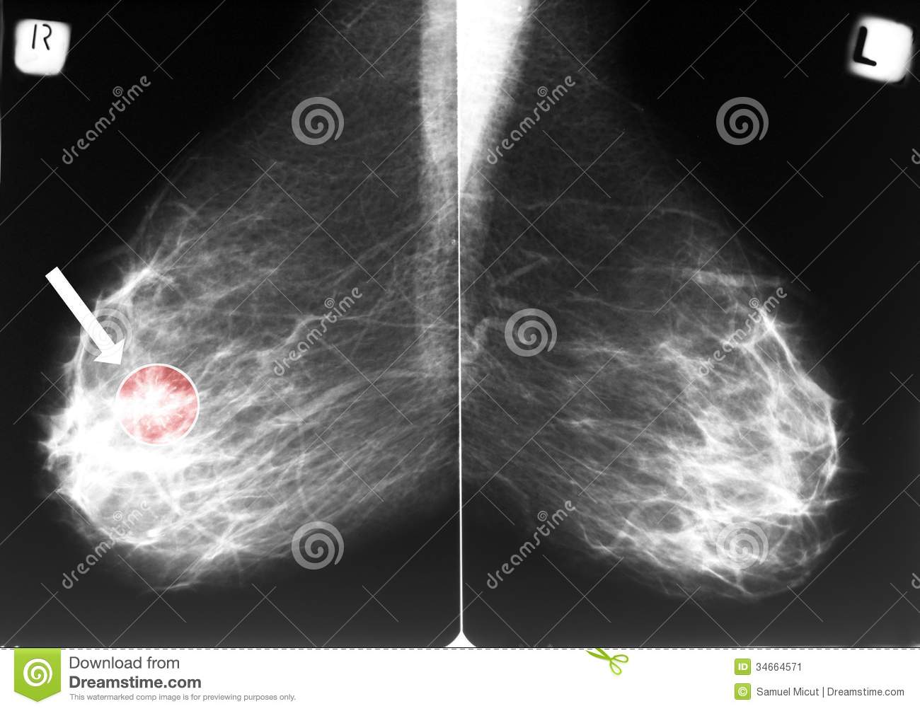 Mammograms Of Breast Cancer Pbcoqfw