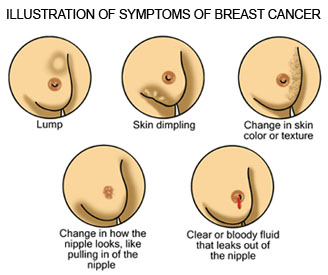 Man Breast Cancer Symptoms Pictures Wallpapers