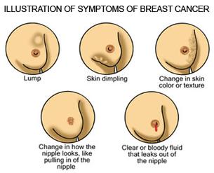Pain In Breast Cancer Symptoms Pictures Wallpapers