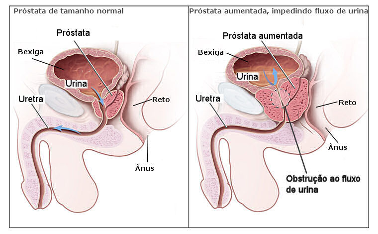 Sintomas Cancer De Prostata Pictures Wallpapers