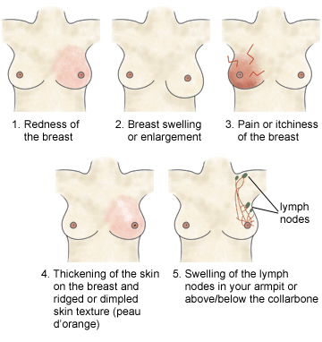 Symptoms Of Cancer Of The Breast Pictures Wallpapers