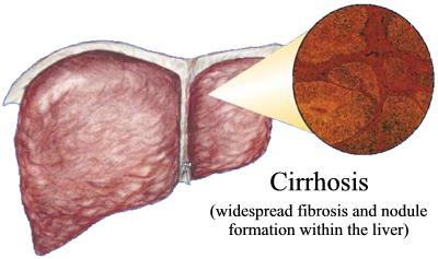 Treatment Of Cirrhosis Of The Liver Healthy Liver And Cancer Fjeqhhfu