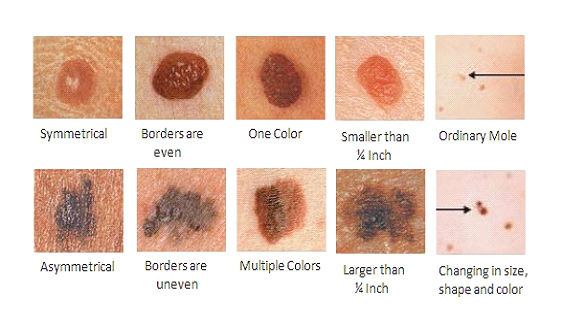 What Is Skin Cancer Screening Bavlscwgf
