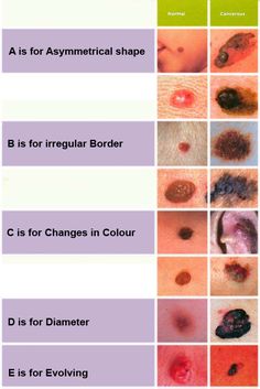 What Is Skin Cancer Symptoms Pktmqaok