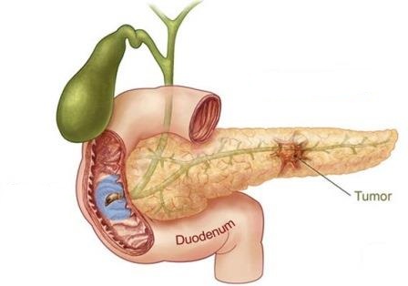Bile Duct Cancer Pictures Wallpapers