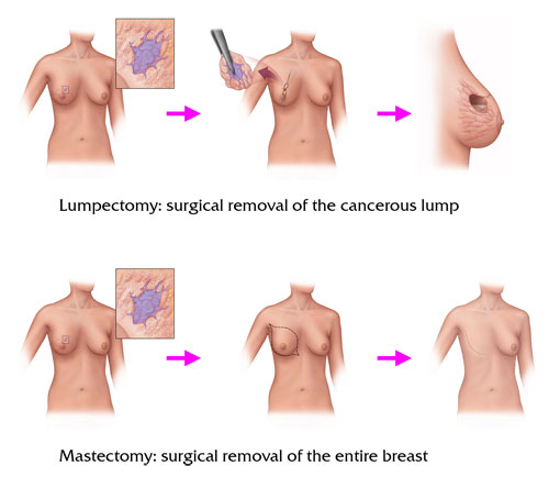 Breast Cancer Treatment Pictures Wallpapers