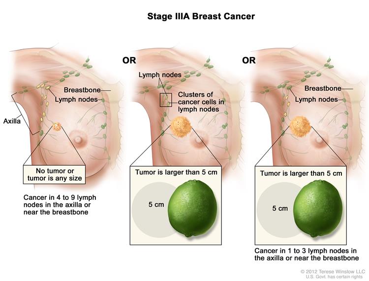 Breast Cancers Ukeuyhcs