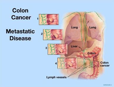 Colon Cancer Staging Xjigwp
