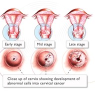 How Do You Get Cervical Cancer Outkczgwp