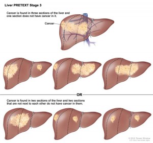 Signs Of Liver Cancer In Women Gmhcidh