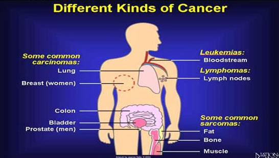 What Causes Cancer Hvzwuewul