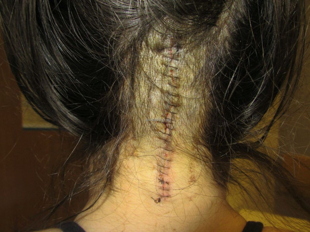 Brain Surgery Scar Pictures Wallpapers