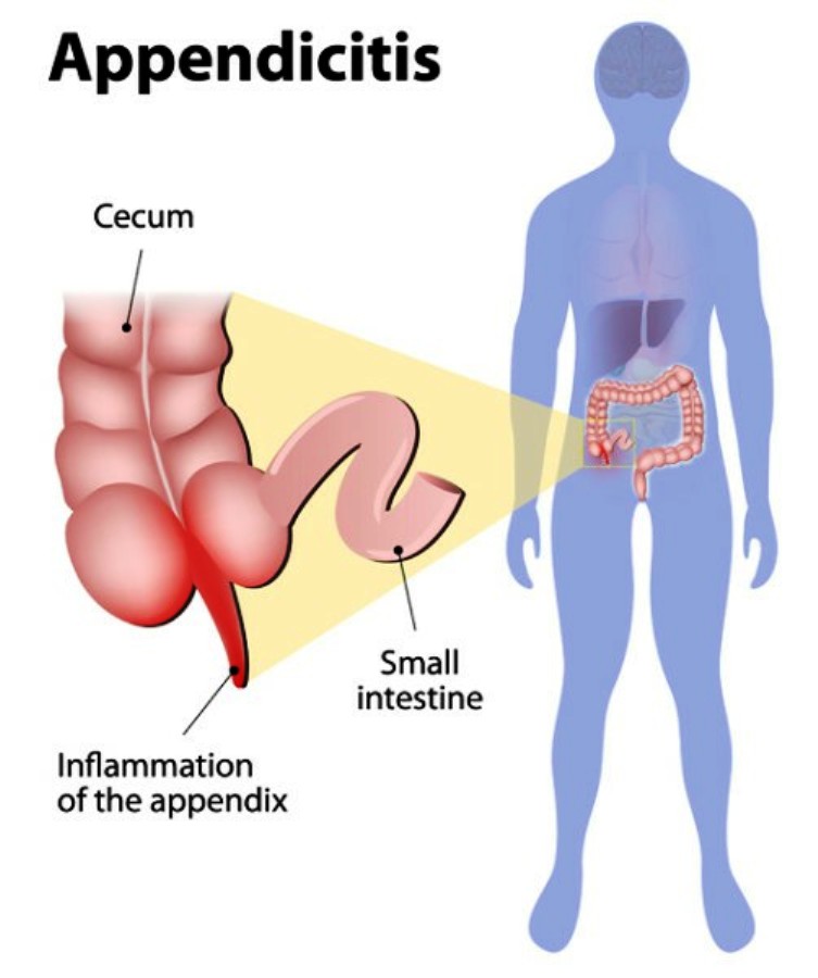 Appendix Pain Pictures Wallpapers