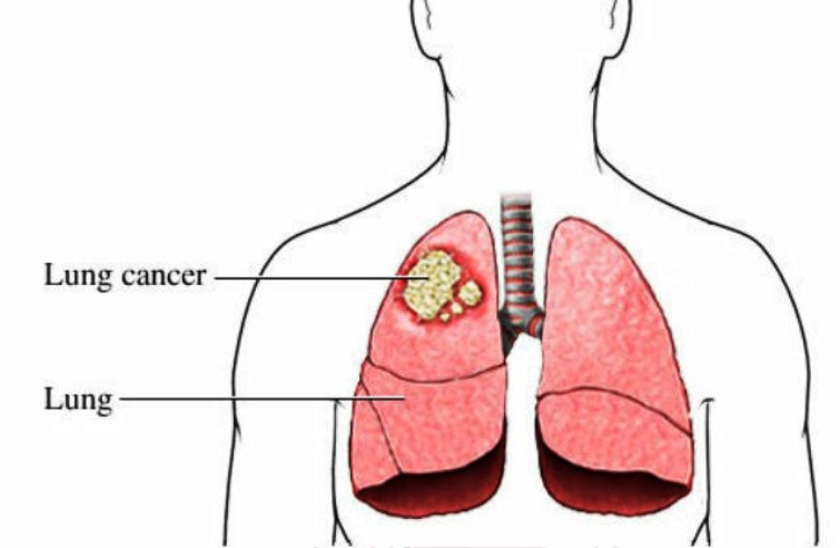 Cancer In Lung Pictures Wallpapers