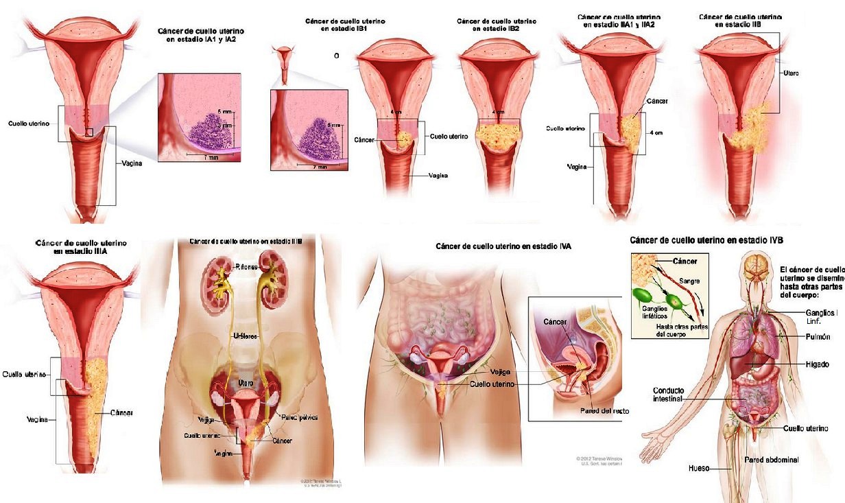 Cancer de Cuello uterino en Estadio IVA
