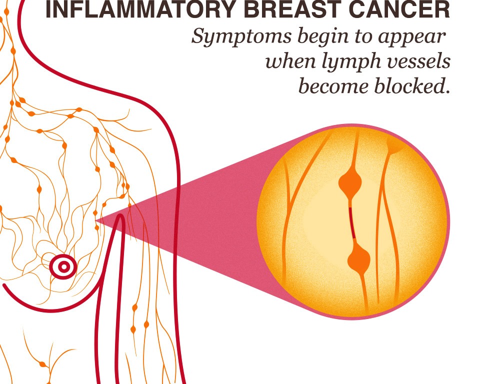 Inflammatory Breast Cancer (IBC) 17272