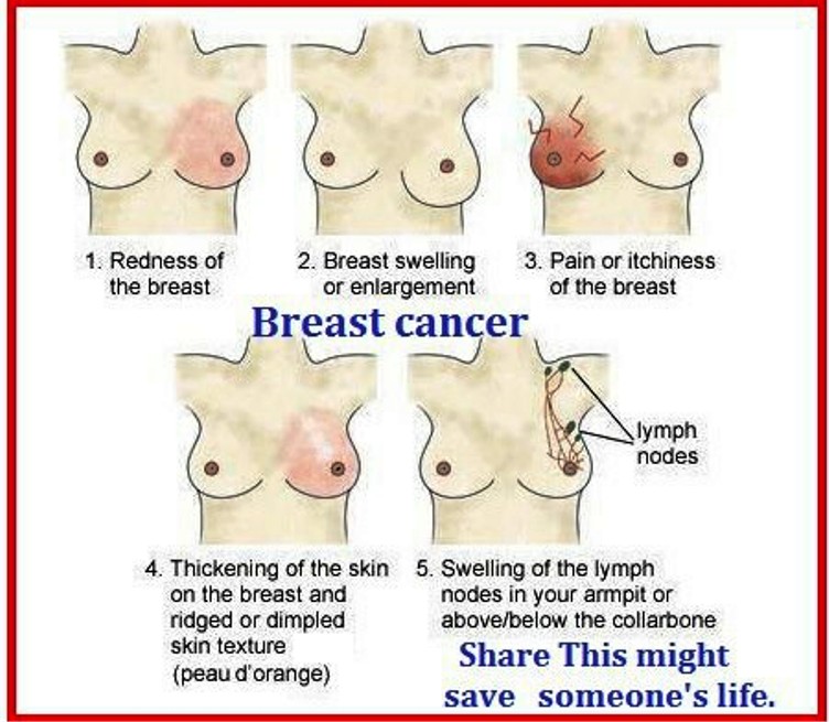 Is Pain In The Breast A Sign Of Cancer Pictures Wallpapers