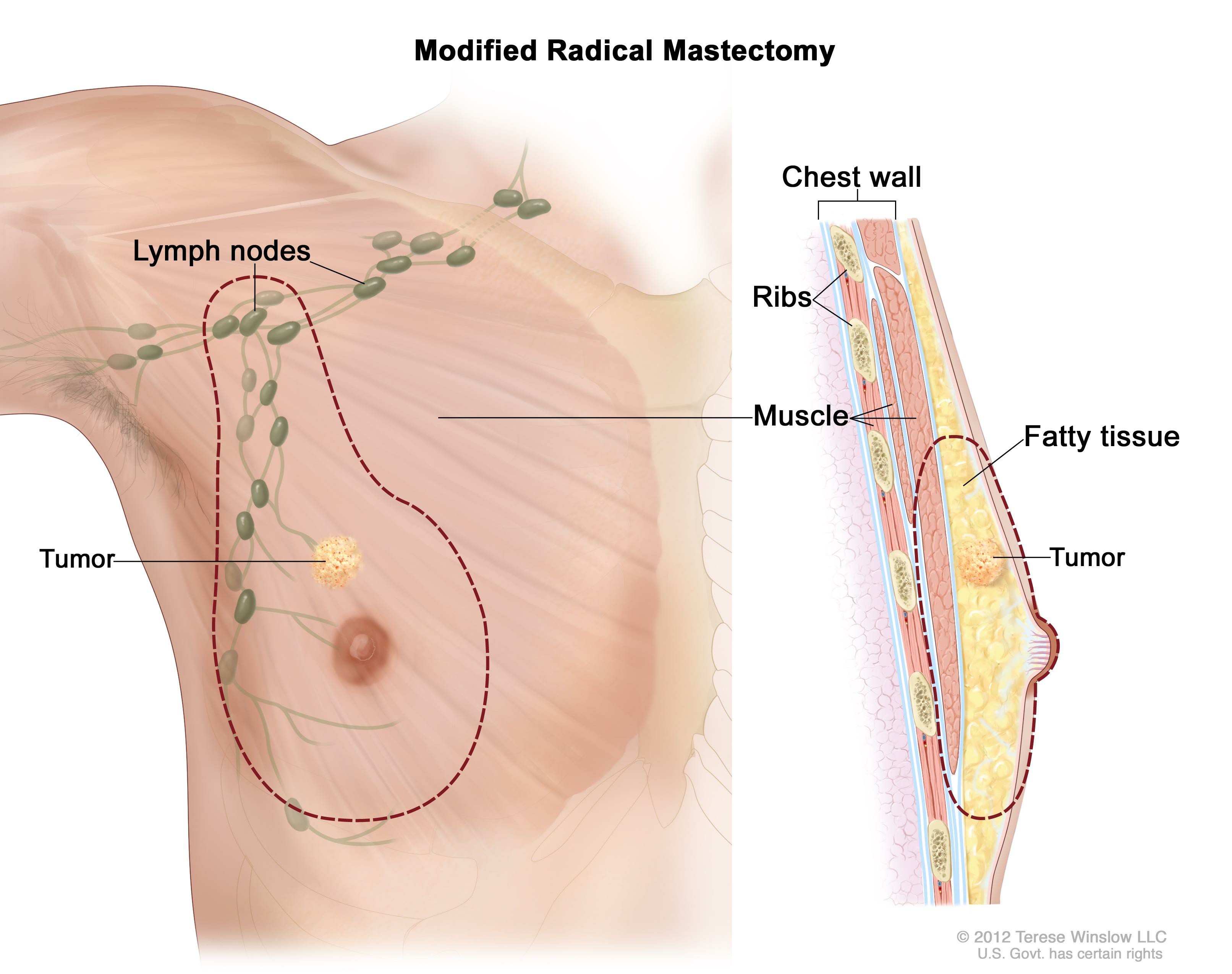 Male Breast Cancer Treatment 152525